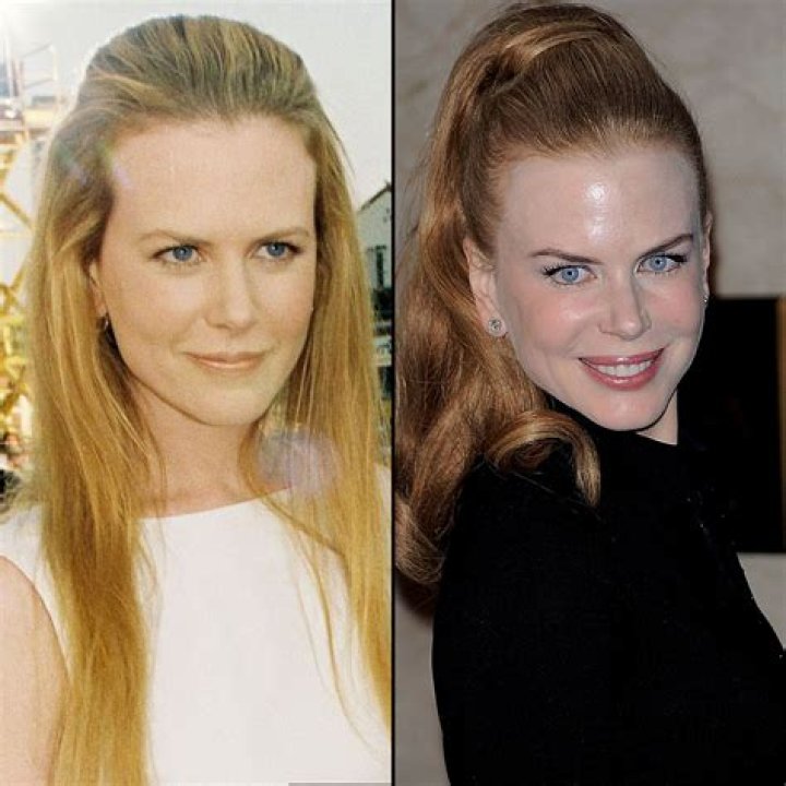Nicole Kidman's teeth transformation in before-and-after photos - what has she had done?
